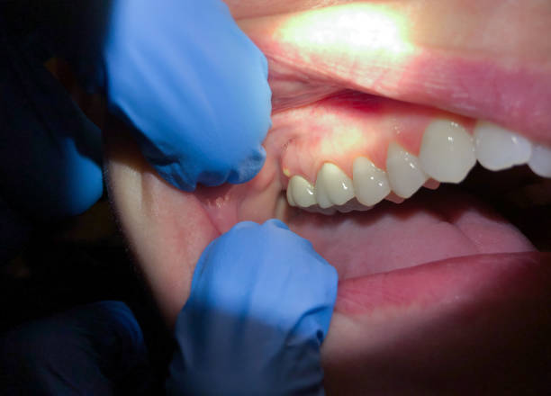 Best Dentist for Tooth Abscess  in Pearl, MS